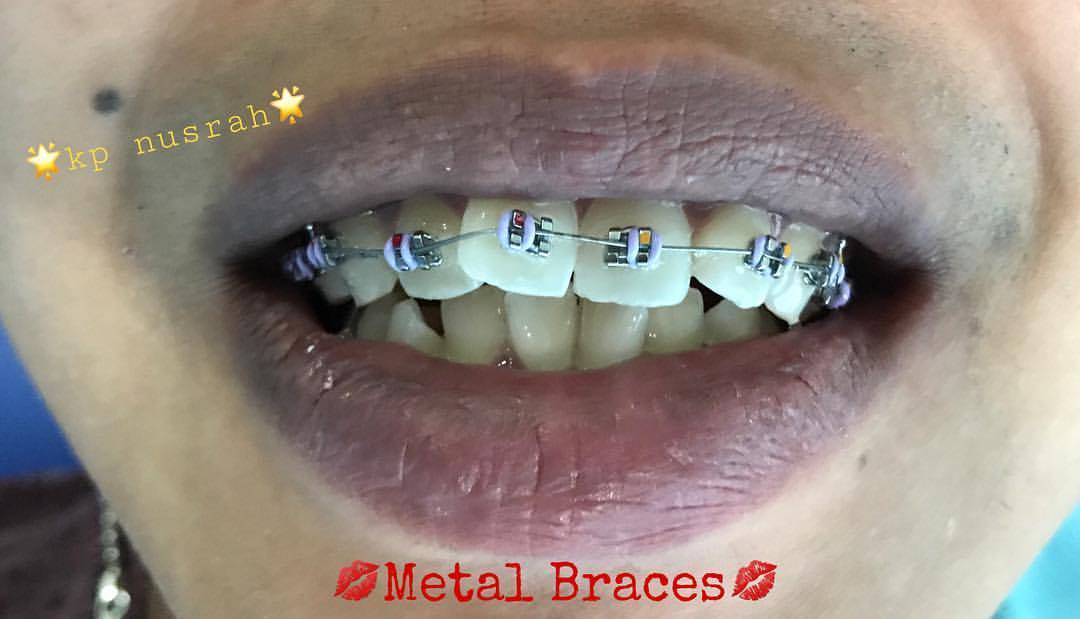 Klinik Gigi Nusrah Malaysia Berminat Nk Pakai Braces Dengan Harga Yang Super Duper Berbaloi Sebarang Temujanji Atau Pertanyaan Sila Hubungi No Di Bawah Call 06 3175119