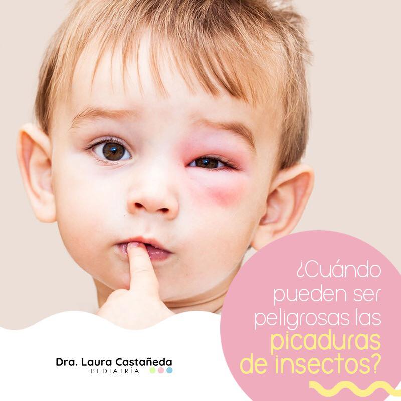 Dra Laura Castañeda - Pediatra - La alergia a las picaduras de insecto ...