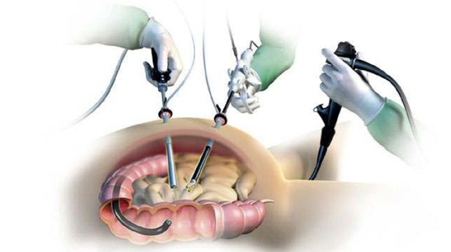 Hyderabad Bariatrics - What do you need to know about Laparoscopic ...