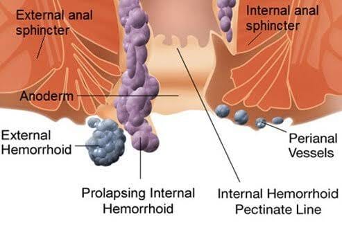 BF Suma Botswana - #HEMORRHOIDS Hemorrhoids also called #Piles. Piles ...