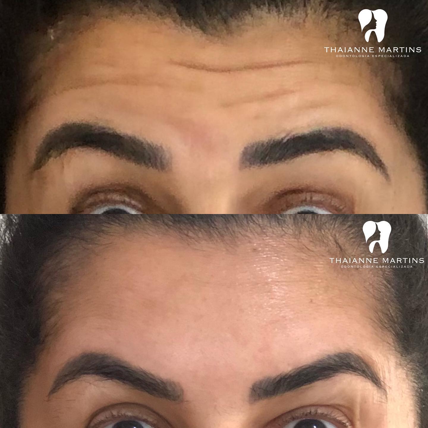 🔸BOTOX Aplicação de... - Consultório Dra. Thaianne Martins