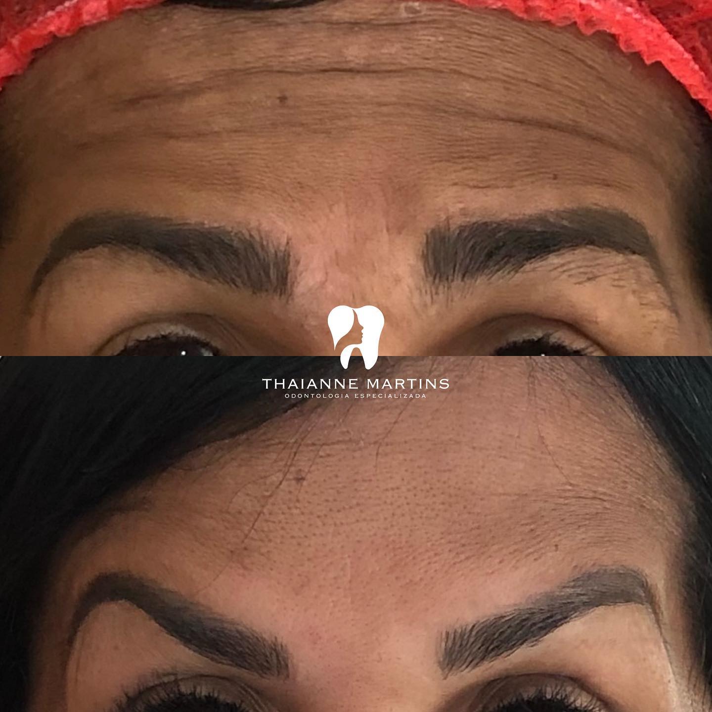 🔸 BOTOX Muitos já se... - Consultório Dra. Thaianne Martins