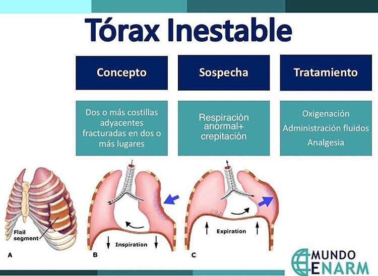 Medicina - ⚠️🚨TORAX INESTABLE 🚨⚠️ . #emergenciasmedic #enfermería # ...