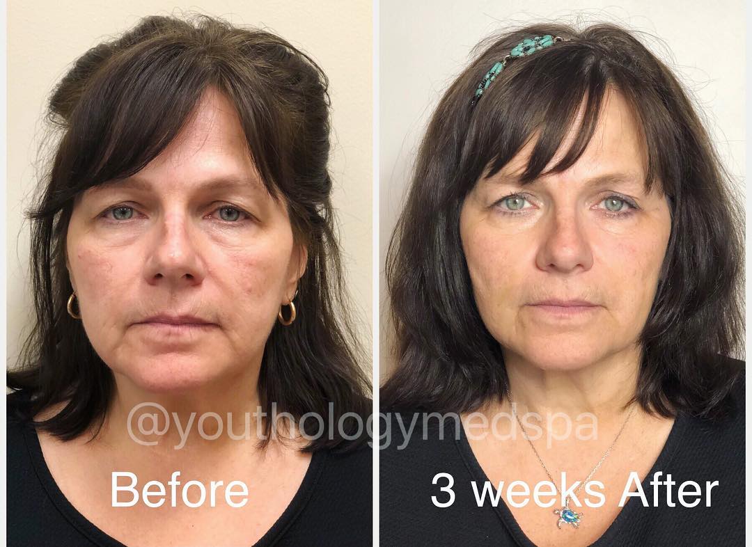 PDO Thread Lifting . Before and 3... - Youthology Medspa