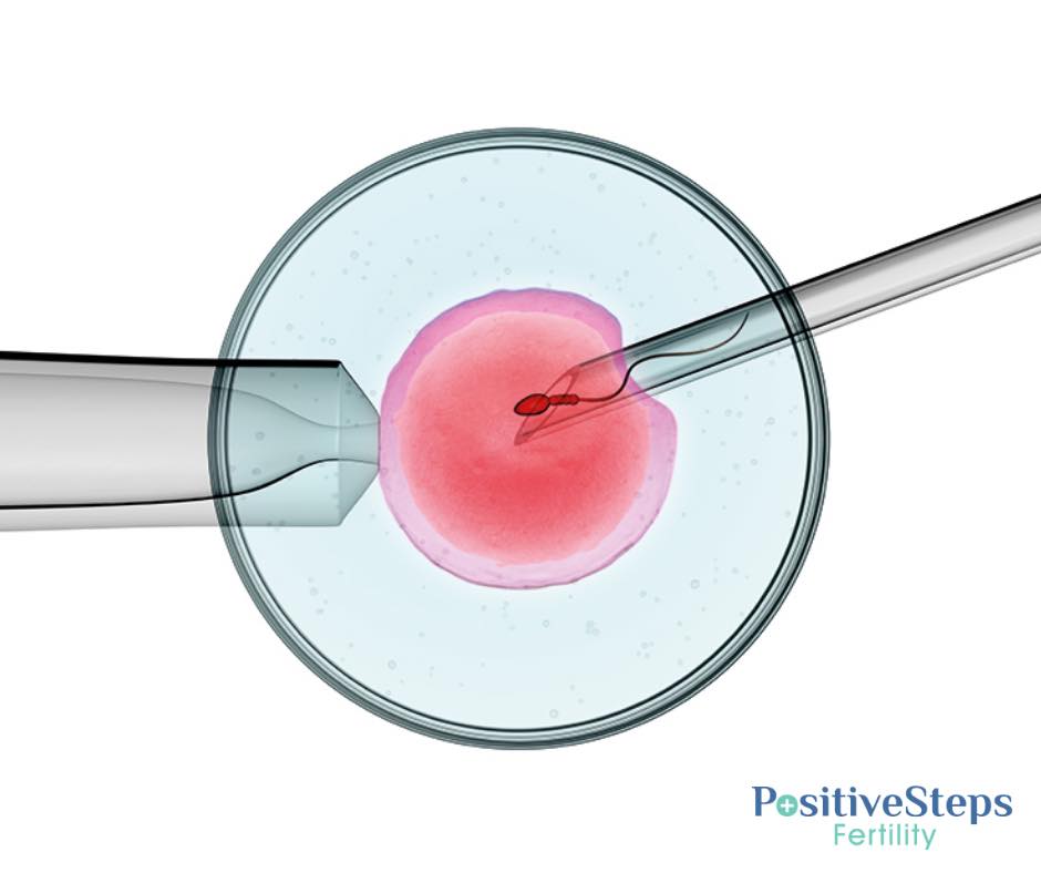 What is Intracytoplasmic Sperm... - Positive Steps Fertility