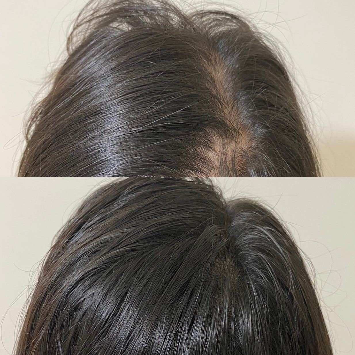 Scalpmicroytb - • This is exactly how #smp treatment looks...