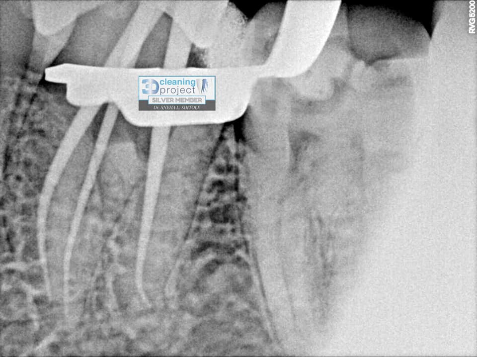 Dr. - How Important is marginal ridge and it's impact on fracture ...