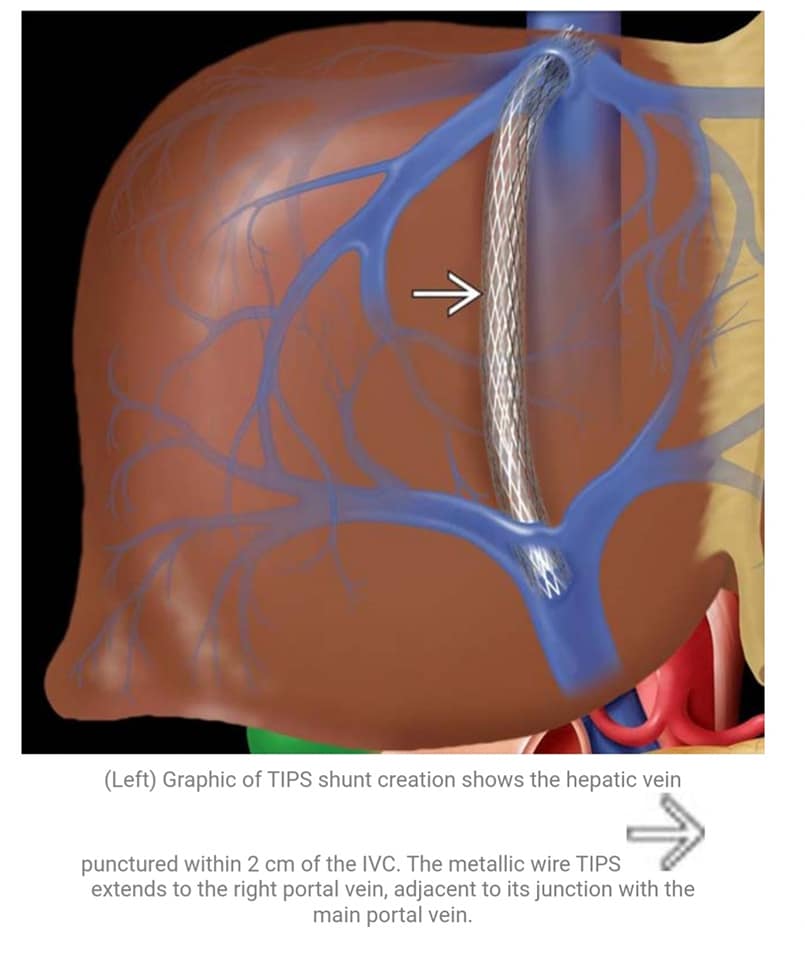 Transjugular Intrahepatic Portosystemic Shunt Diagram