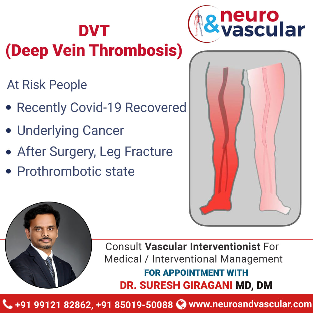 DVT - Deep Vein... - Stroke and Vascular interventions | Facebook