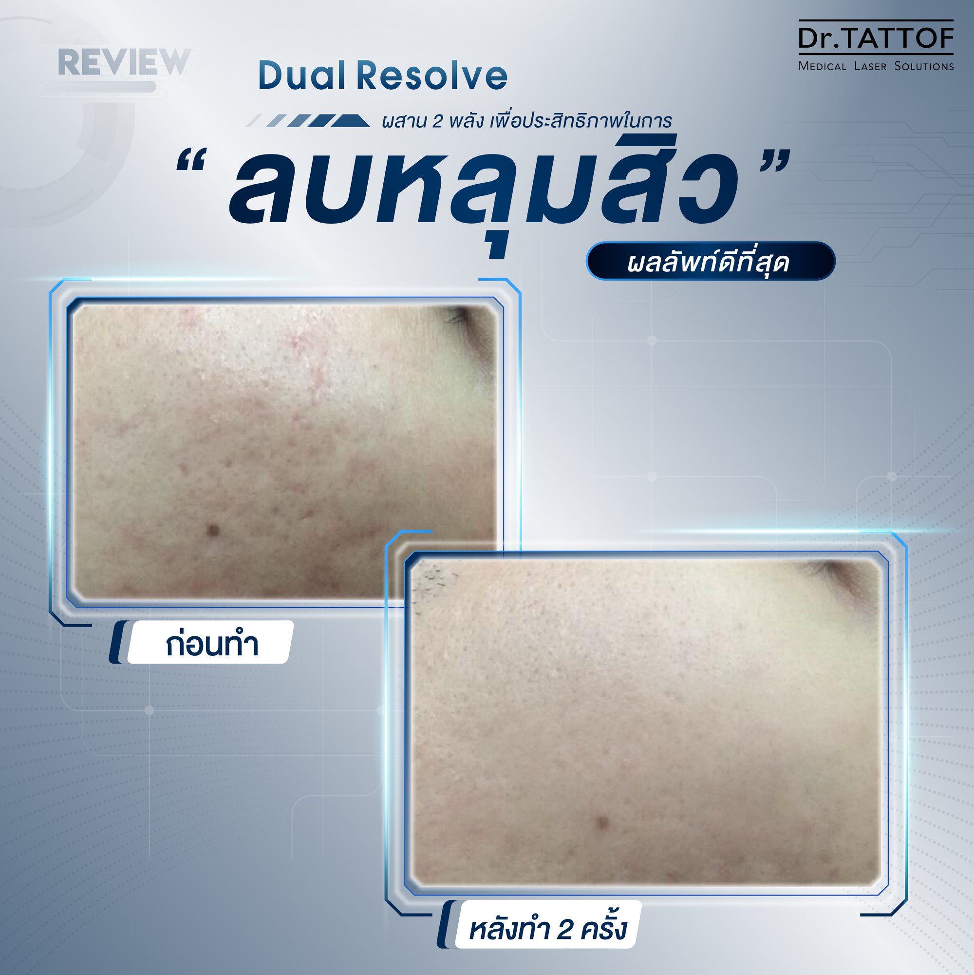 Dr.TATTOF - 💖 Review >> Dual Resolve Program ผสาน 2 พลัง... | Facebook