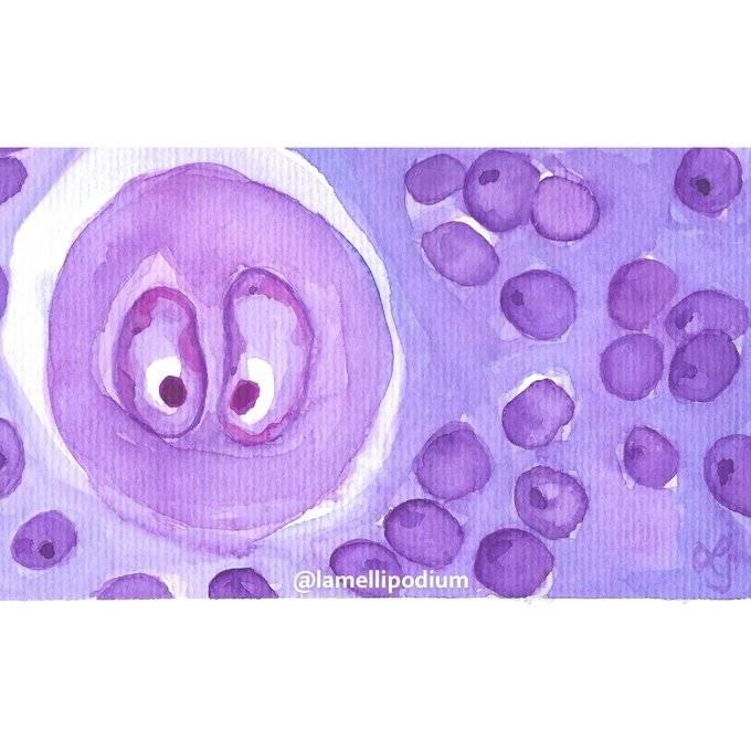 Reed Sternberg Cells