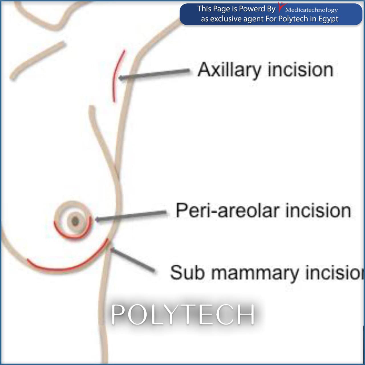 POLYTECH Egypt - Incision and position of the breast...