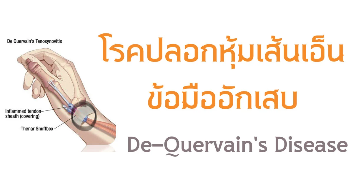 de-quervain-s-disease