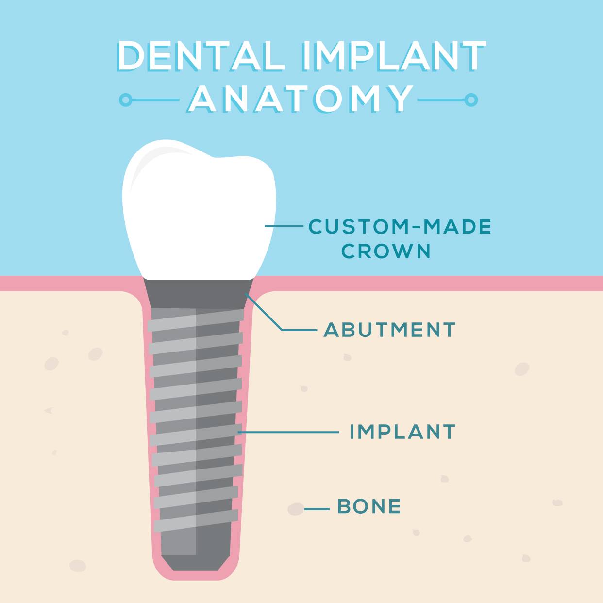 Pollock Advanced Dental Group - DENTAL IMPLANTS have the same ...