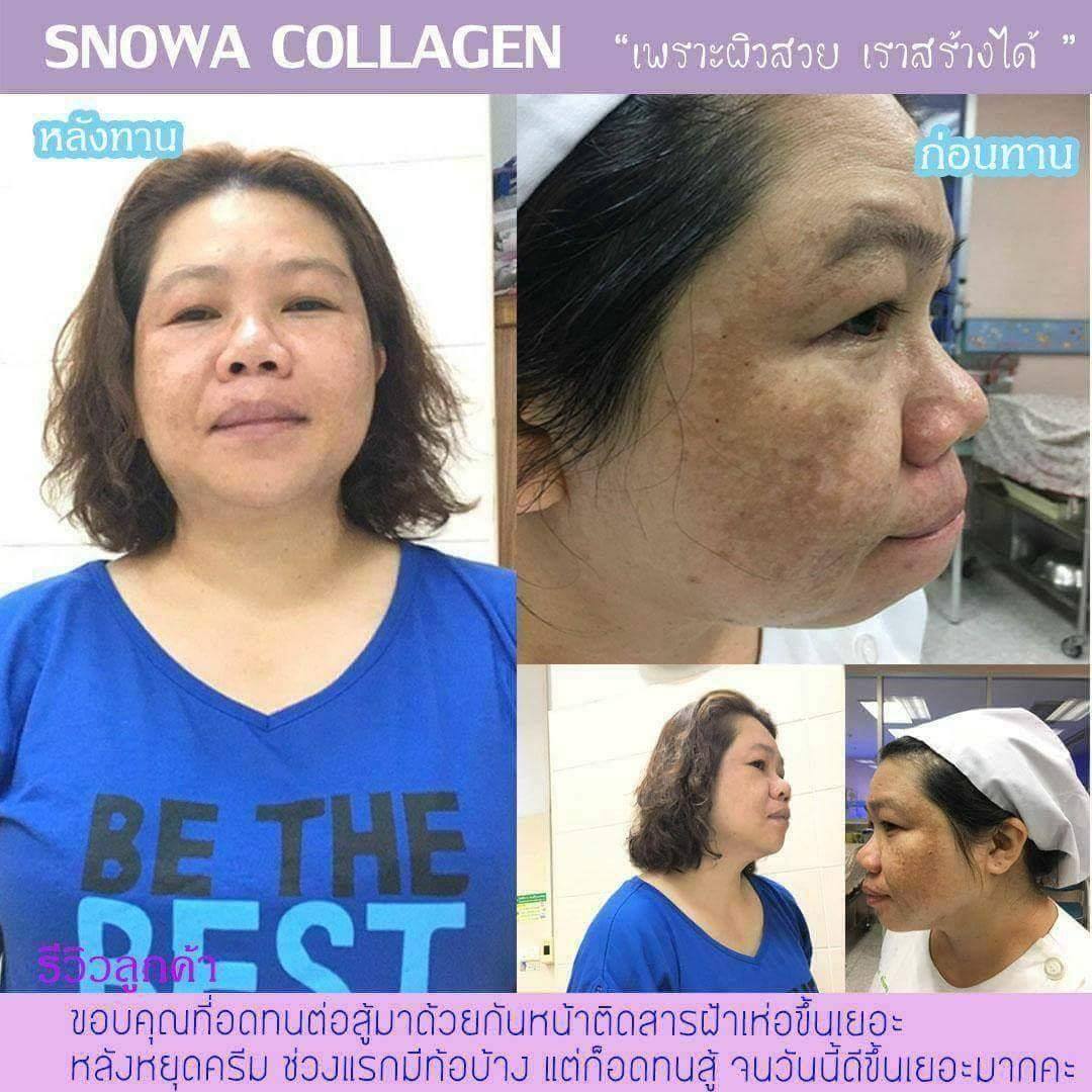 ฝ้าสารเคมี เพราะใช้ครีมแรงๆ... - Snowa Collagen TH 4289