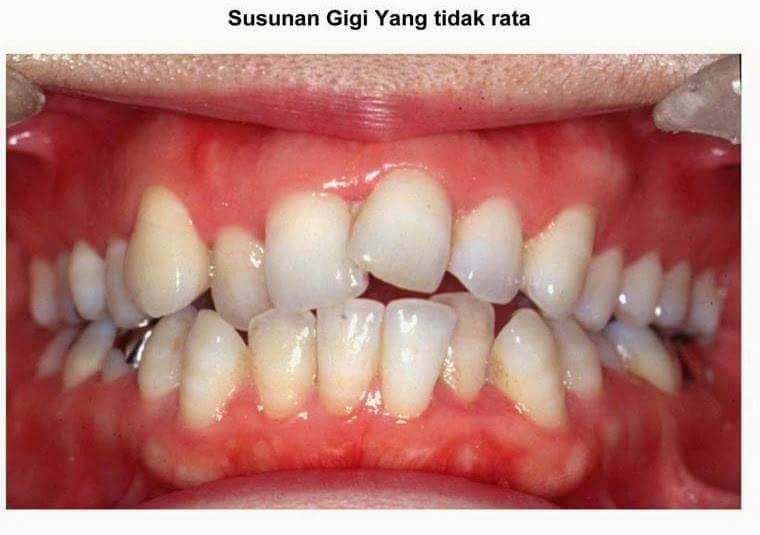 Mengapa Gigi Jadi Tidak Teratur Klinik Pergigian Asmah Facebook