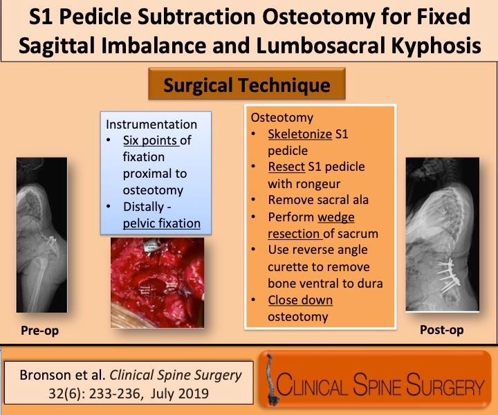 Clinical Spine Surgery How Can You Fix Severe Lumbosacral Kyphosis Find Out Here Clinical Spine Surgery Http Bit Ly 2xjpt9u Surgical Video Http Bit Ly 2izv2kc Spine Spinesurgery Visualabstract Kyphosis Osteotomy Facebook