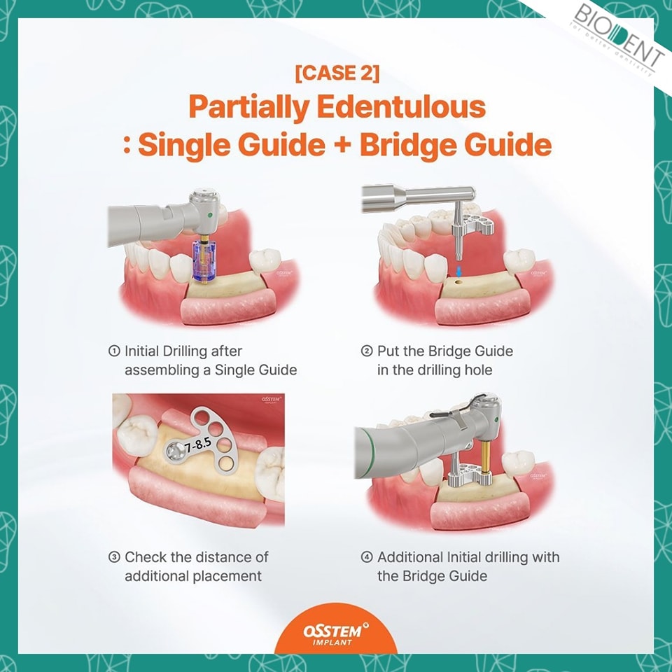 Biodent_lk - Introducing the @osstem Positioning Guide KIT...