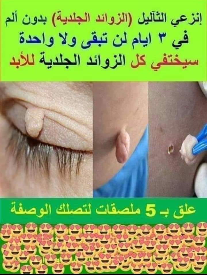 تكلفة ازالة الزوائد الجلدية التجميد والربط والكي تجميلي