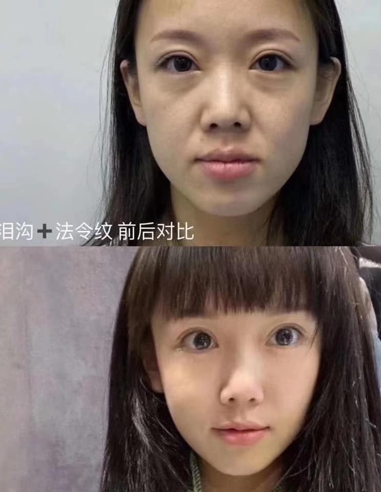 Mirabelle Aesthetic 医美微整形 泪沟 法令纹去除做了法令纹 泪沟很多人年纪轻轻就出现了真的要后悔没有早点做因为做完了真的年轻了太多了 Facebook