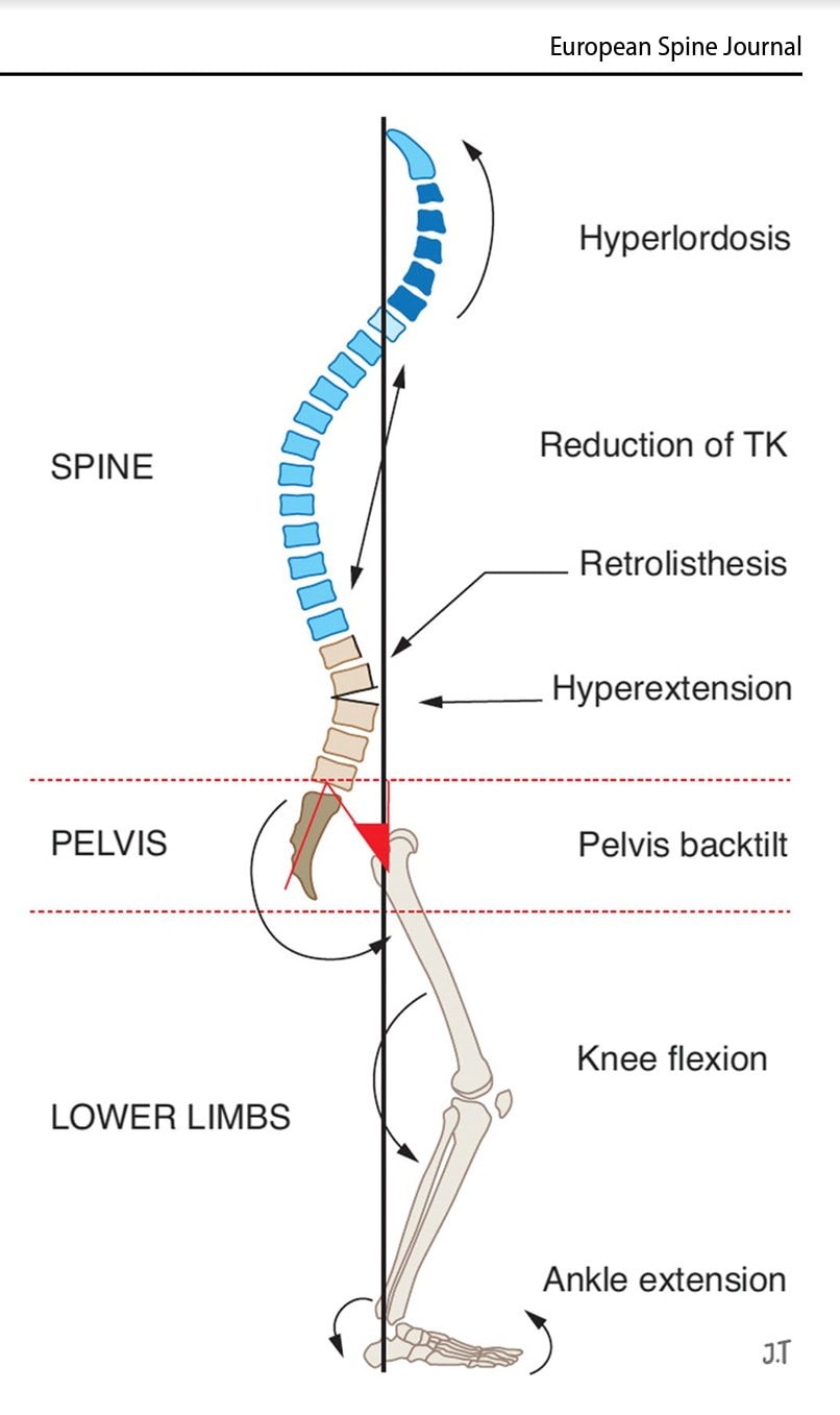 Compensation mechanisms for... - Physio Online Courses | Facebook