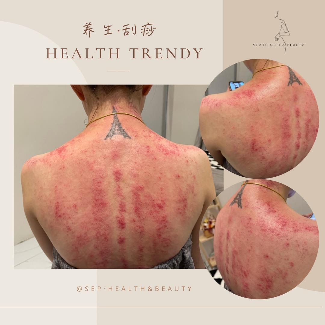 Yvonne·养生·刮痧·HealthTrendy | Bukit Mertajam