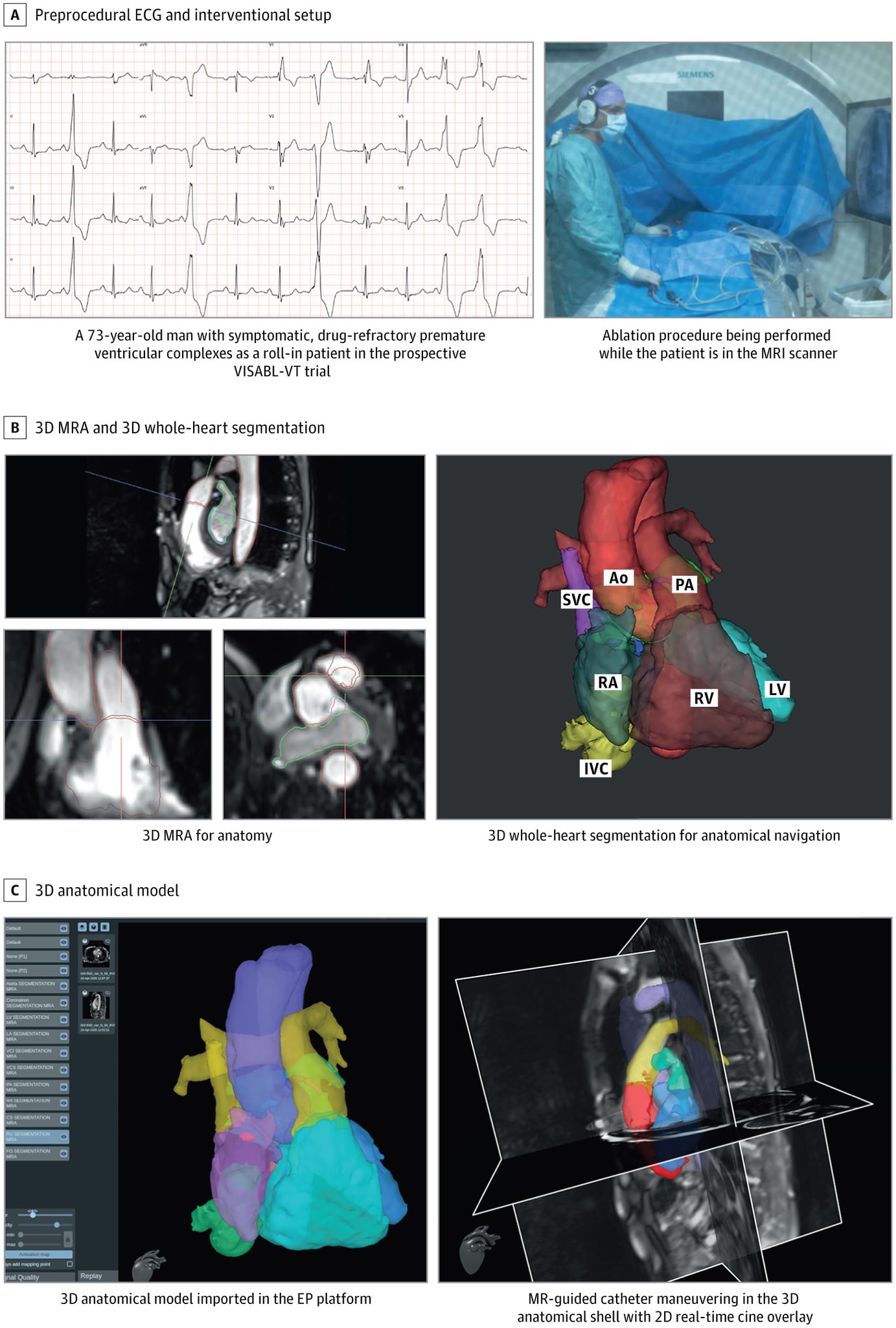 JAMA - Real-time MRI-guided ventricular ablation was demonstrated as a ...