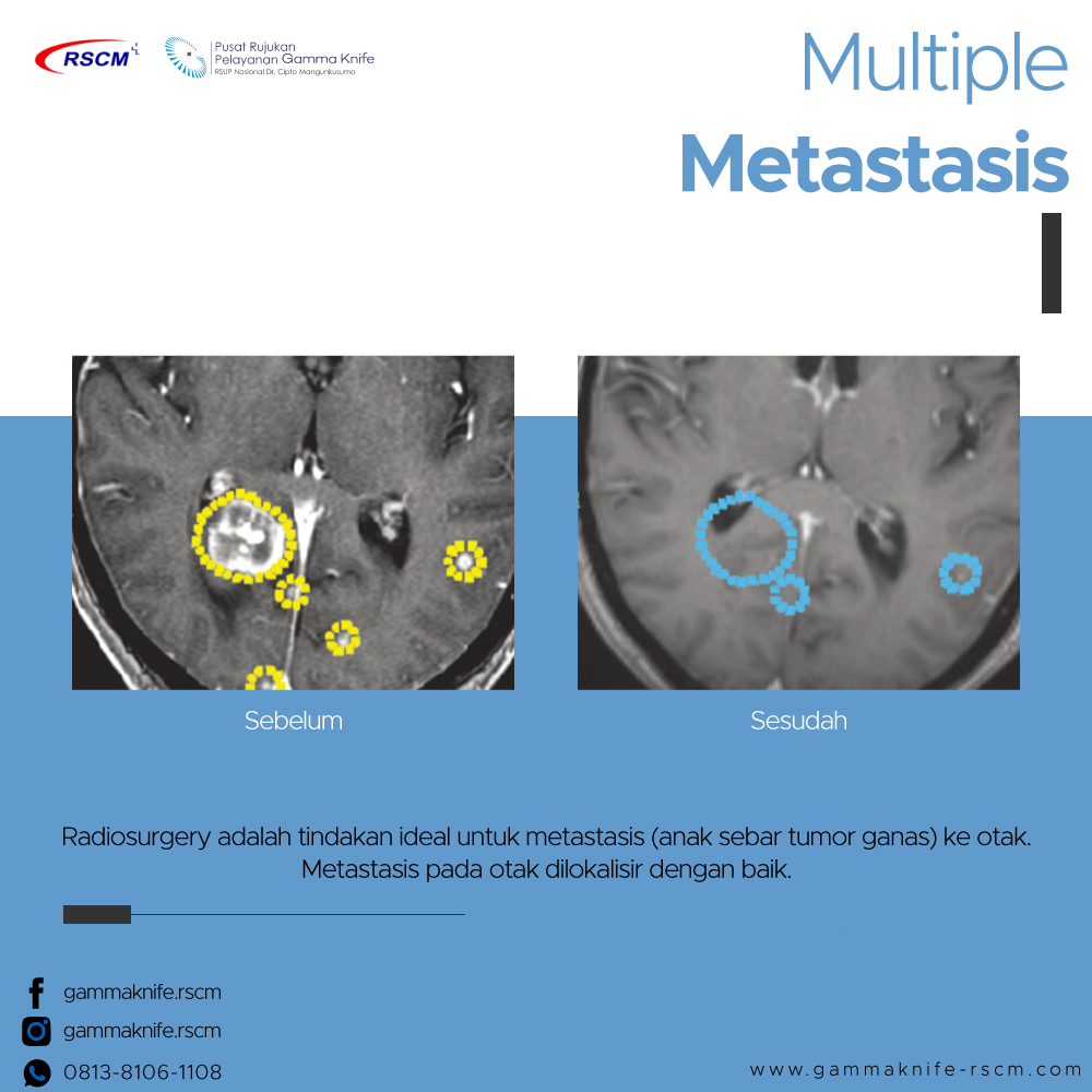 Simak hasil pencitraan setelah terapi... - Gamma Knife RSCM