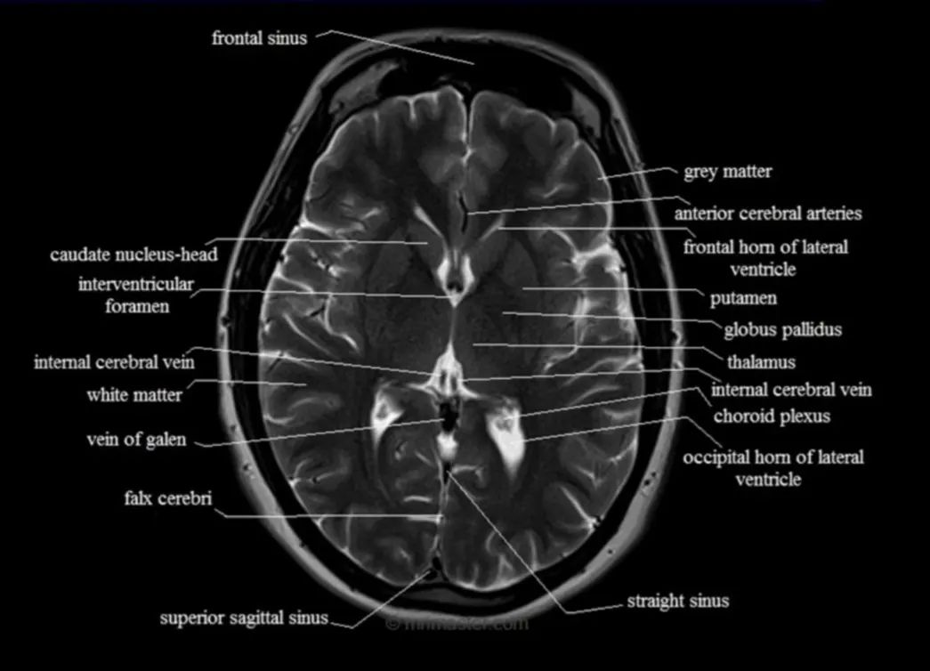Radiographic Anatomy of Brain MRI... - Medical Radiologia