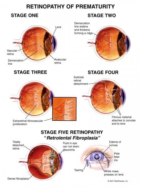 there are different stages of ROP... - Being an Optometrist | Facebook