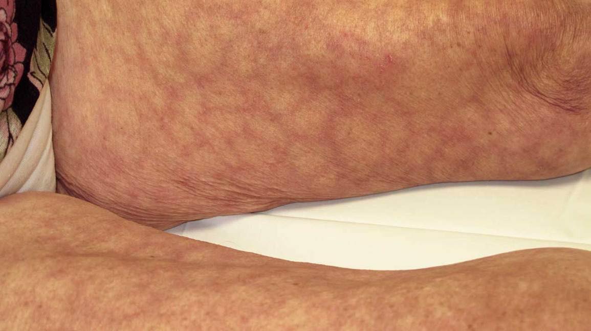 Secondary Livedo... - Manifestations of Livedo Reticularis | Facebook