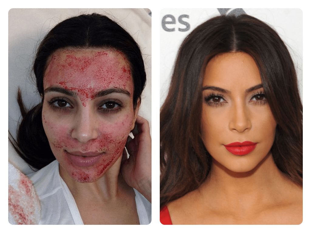 kim kardashian glutathione skin Platelet Rich Plasma (PRP) therapy, also known as the 'Vampire Facelift' made famous by Kardashian! This type of facial works on the basis that the body's own natural healing may slow 3 Belo Nutraceuticals Glutathione non-GMO glutathione supplement Size:25 Kilogram (55 lbs)