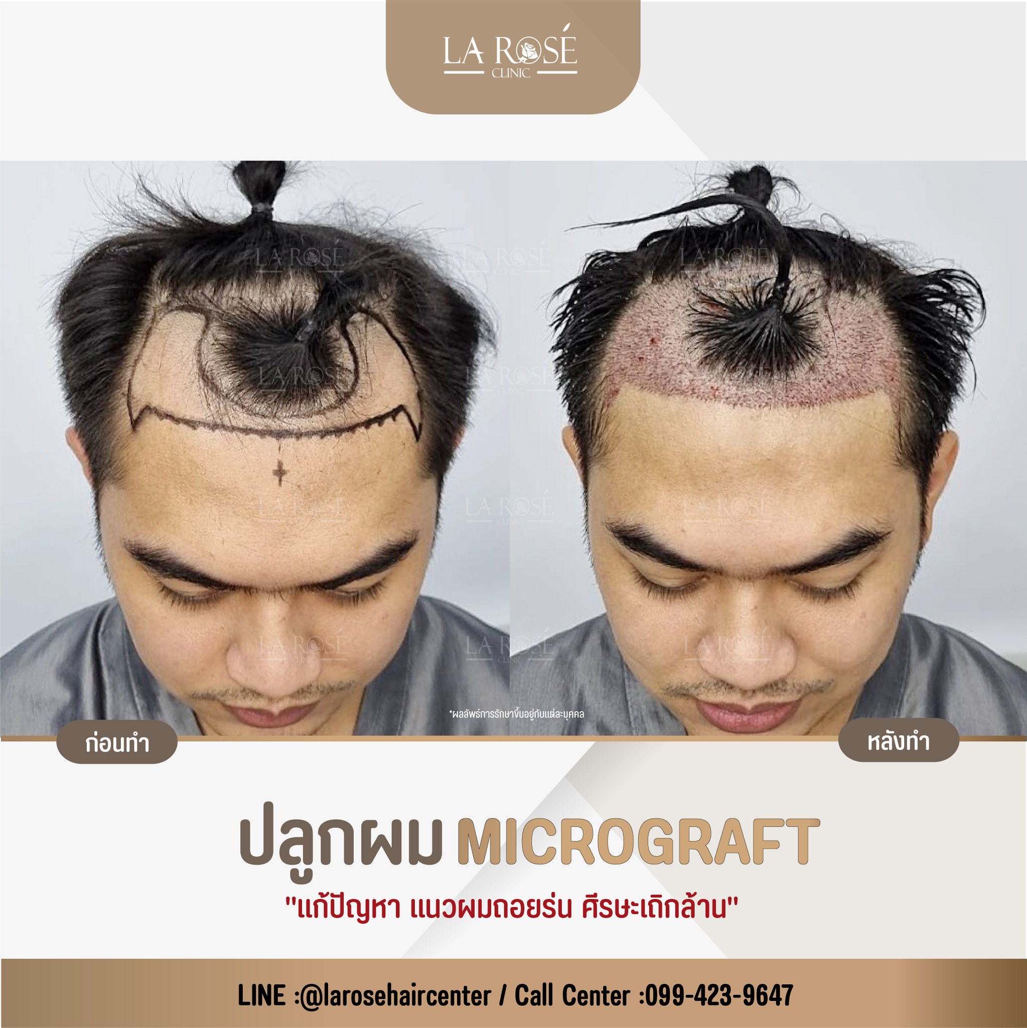 ส... - Larose Clinic โปรแกรมปลูกผม FUE Micrograft DHI Longhair | Facebook