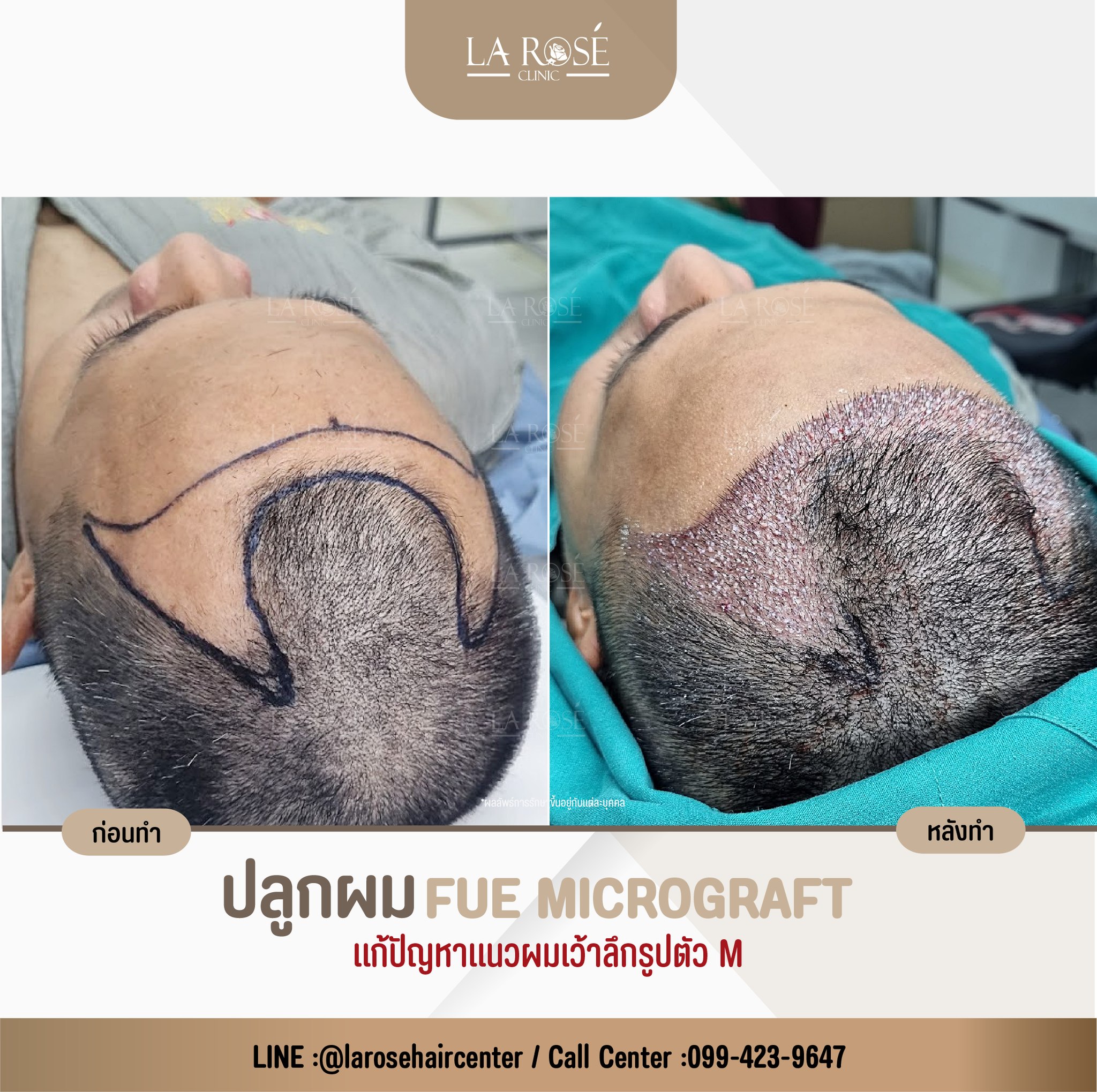 แ... - Larose Clinic โปรแกรมปลูกผม FUE Micrograft DHI Longhair | Facebook