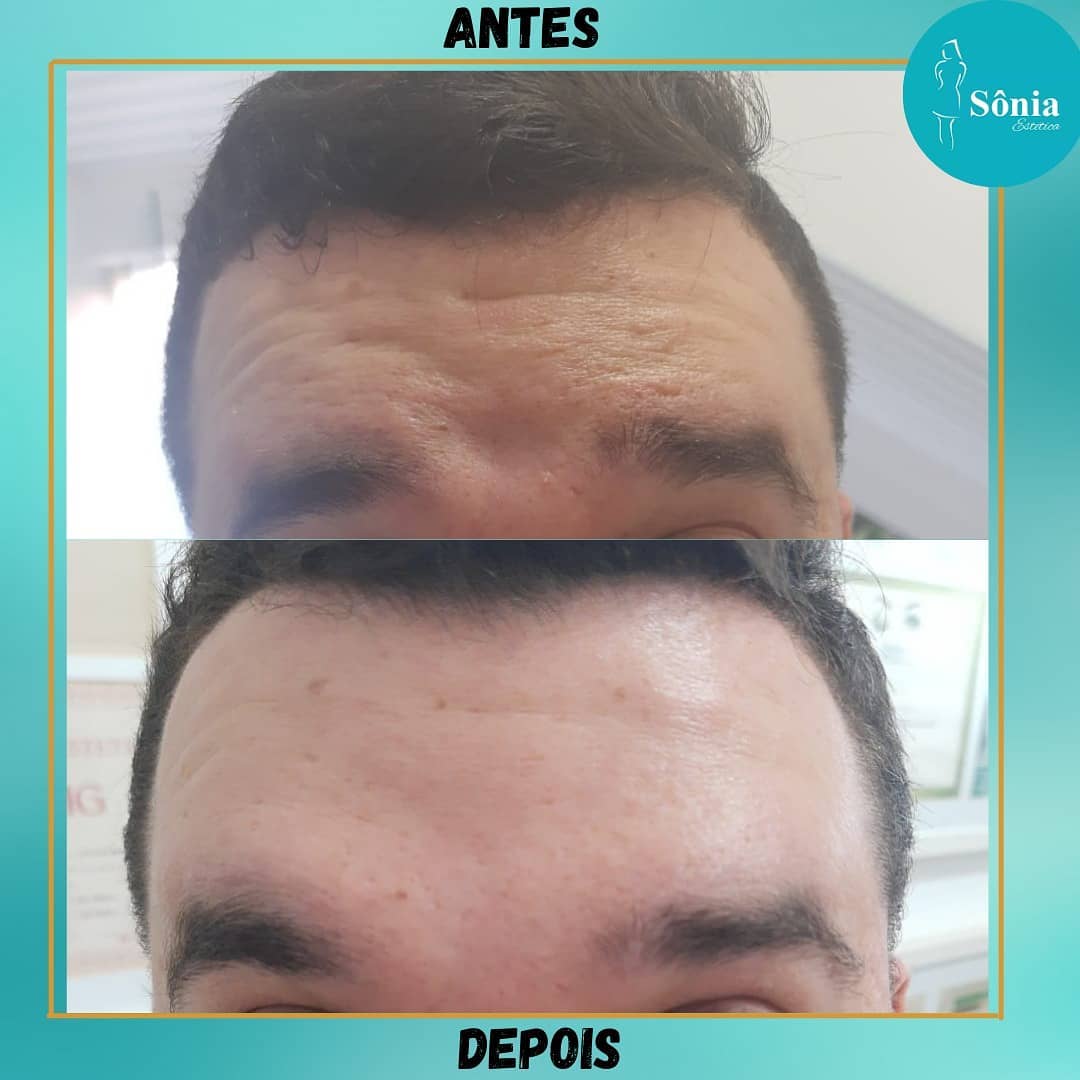 Botox. Quem não ama ter a pele... - Clínica Sônia Estética