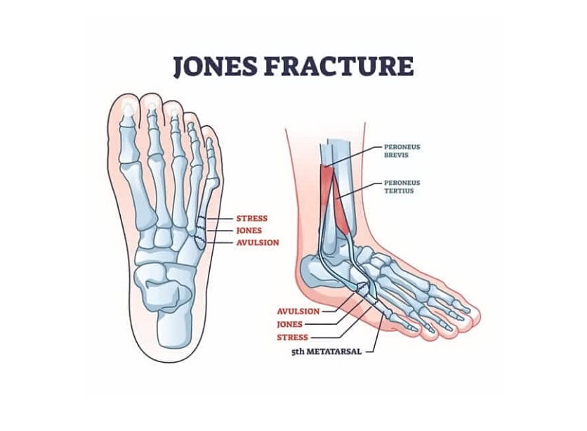 🆕Blog Post⤵️ A Jones... - Southwest Foot And Ankle Center | Facebook