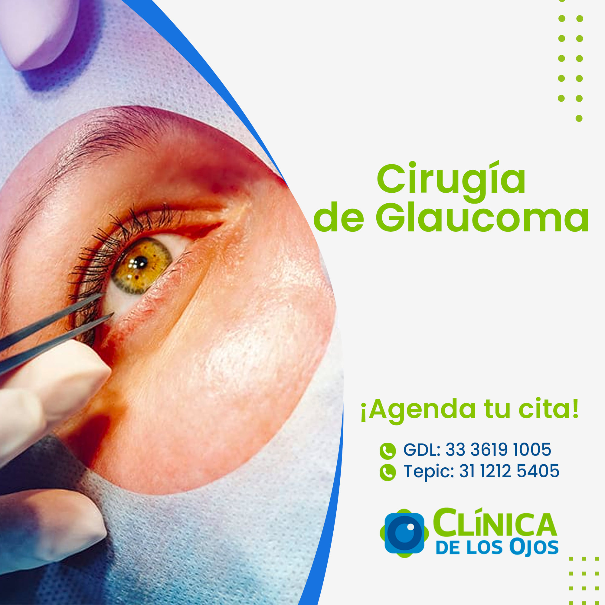 El Glaucoma puede en una temprana... - Clínica De Los OJOS