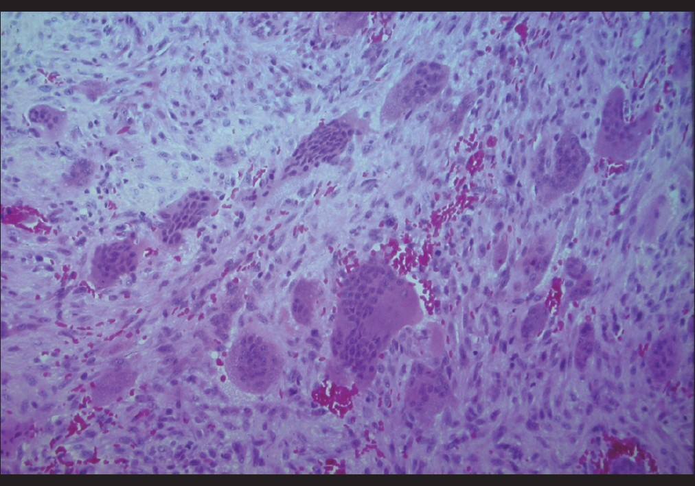 Torus Mandibularis Histology