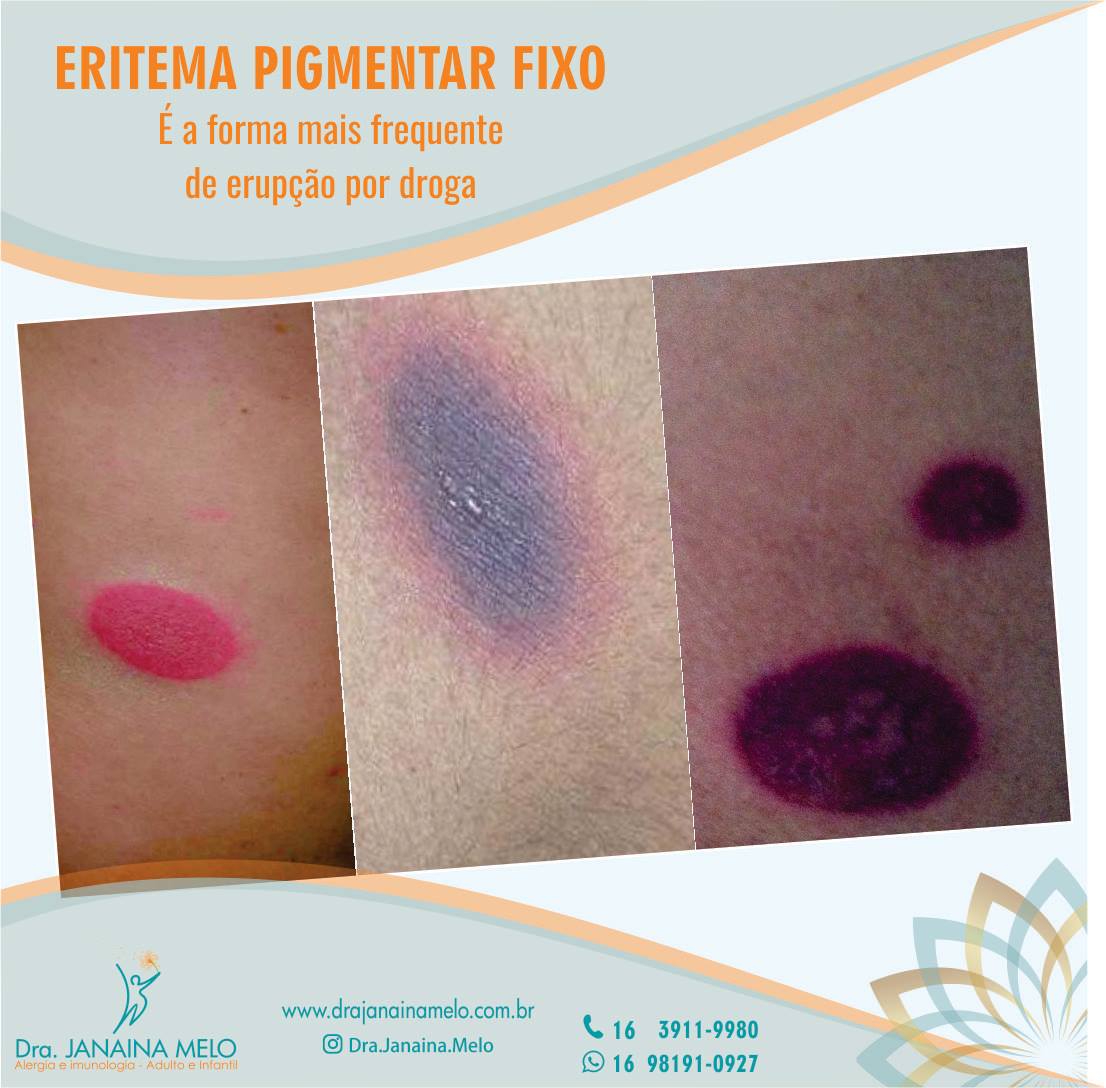 dra-janaina-melo-alergista-e-imunologista-eritema-pigmentar-fixo