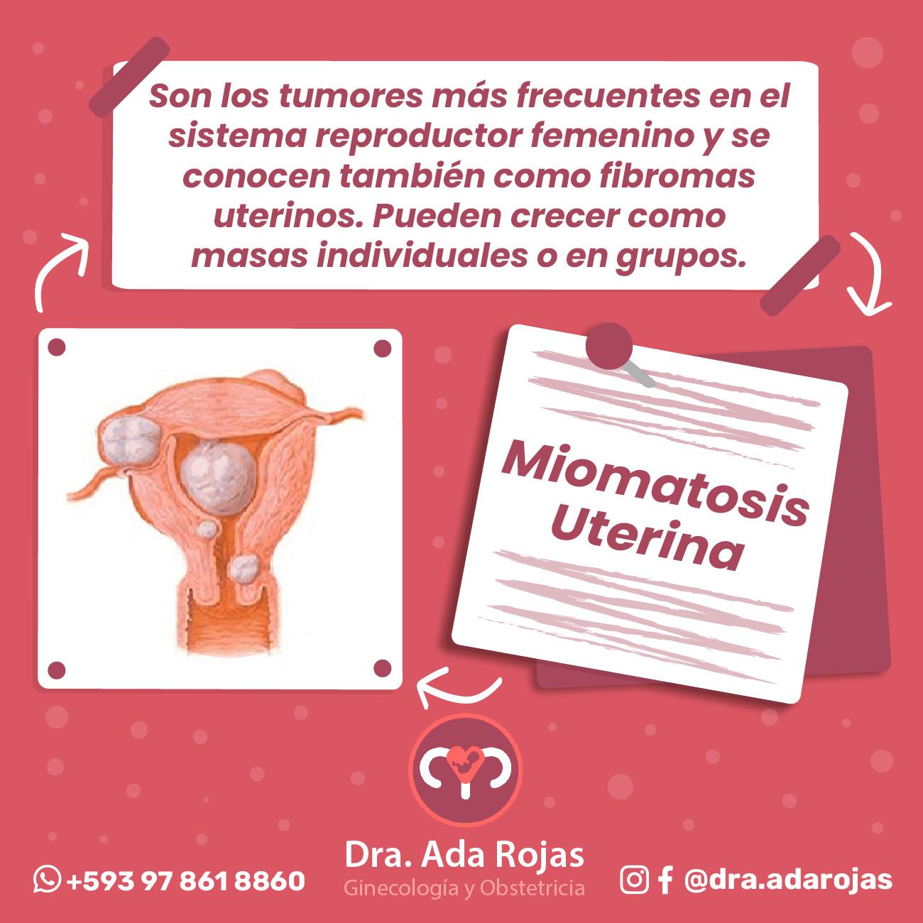 Dra. Ada Rojas - Los miomas son tumores benignos del...