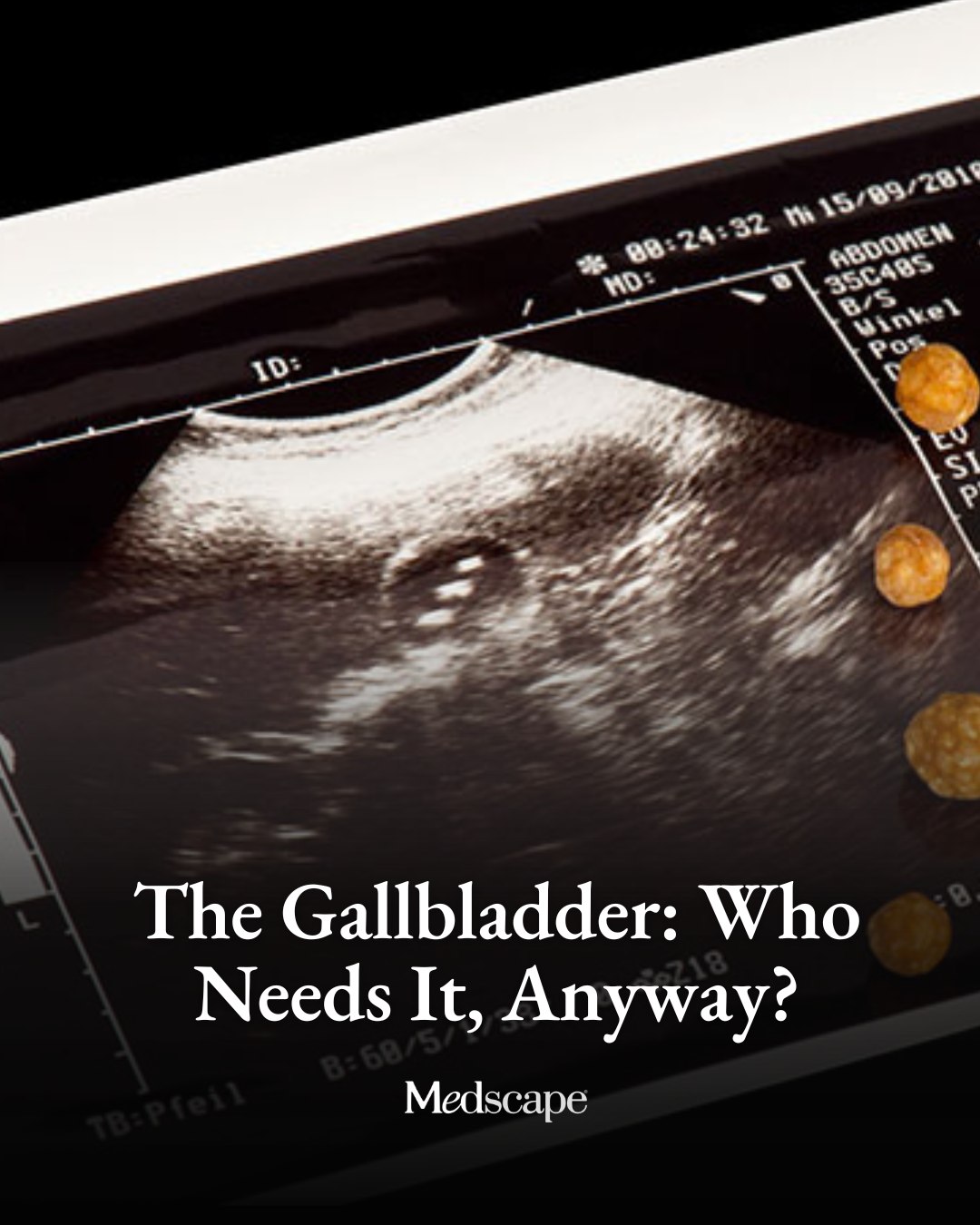 While the gallbladder is not essential for survival, its removal can have more significant consequences for bile regulation and long-term digestion than previously recognized. Modern clinical perspectives suggest that surgeons and primary
