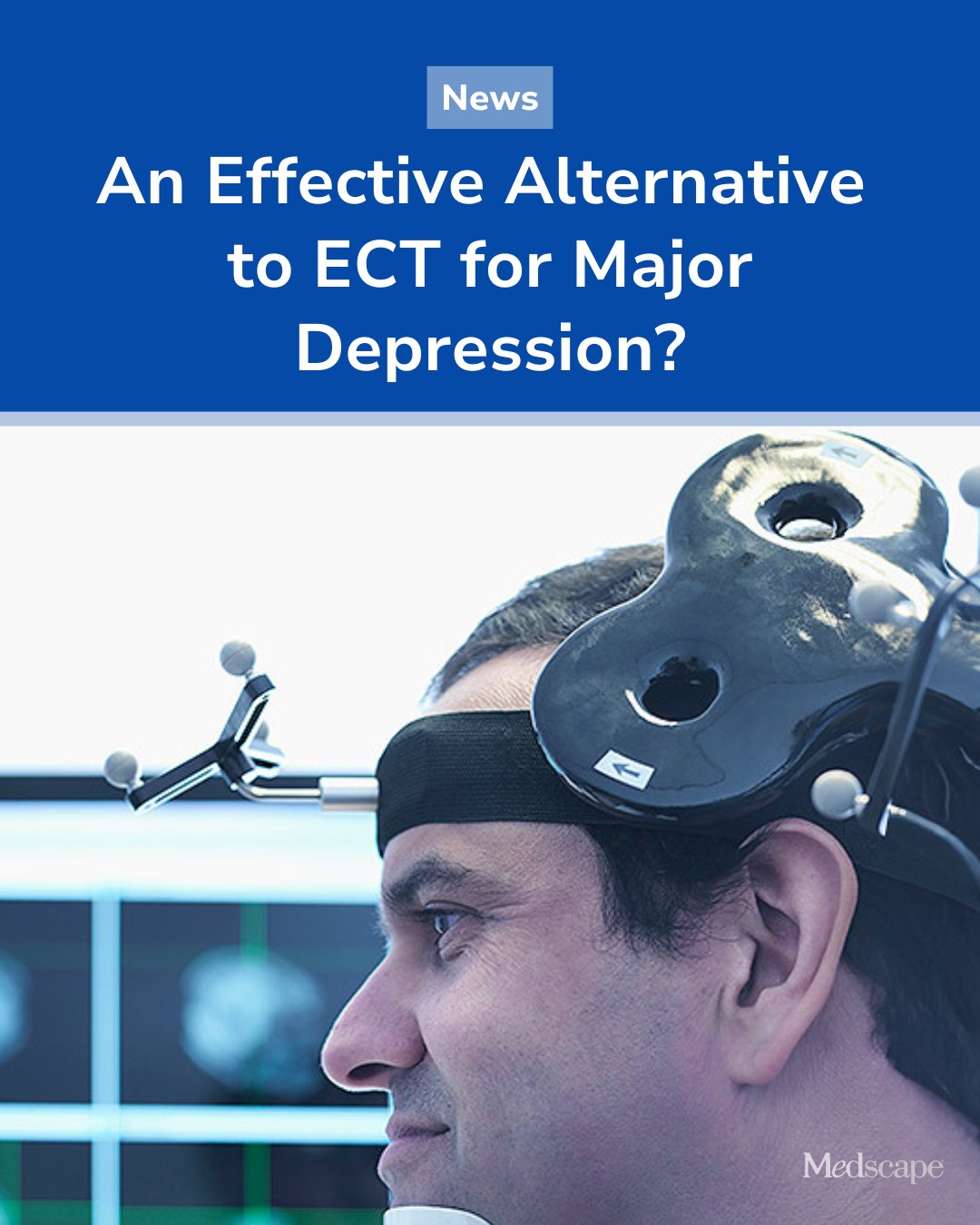 プレーステーション　セット Magnetic seizure therapy (MST) matched electroconvulsive therapy