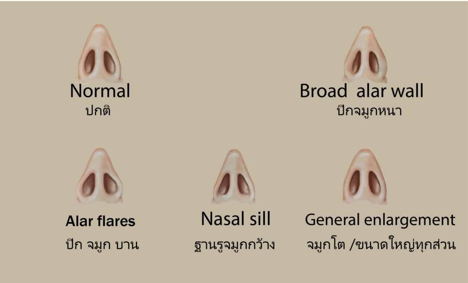Dr.Gorn - ปัญหาของปีกจมูกที่พบได้บ่อย มี 2 ลักษณะคือ - ปีกจมูกหนา ...