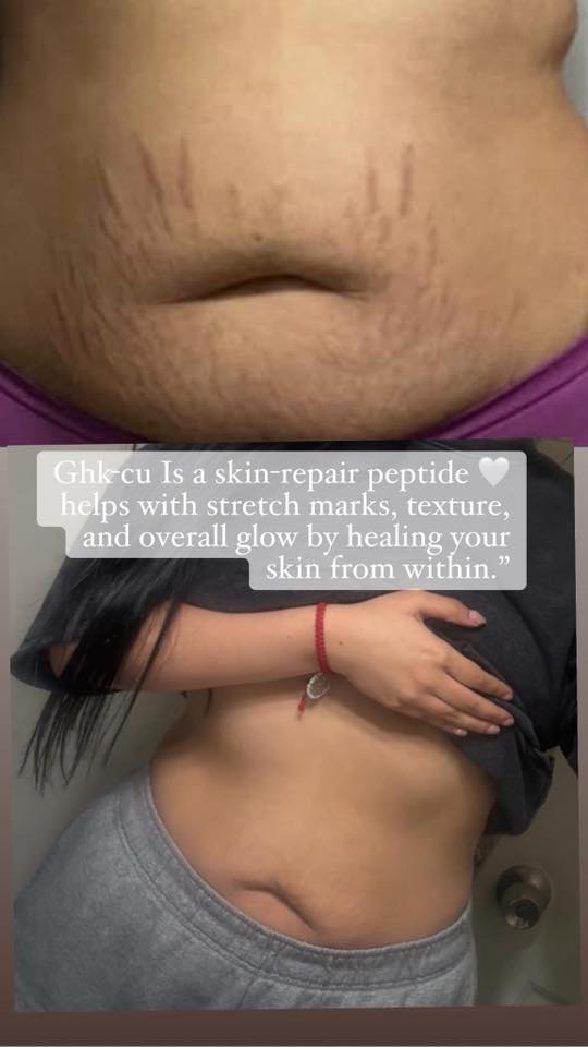 does ghk cu help with stretch marks thoughts on peptides? specifically Color:Ocean oxidized-glutathione 5 Best Glutathione Supplements