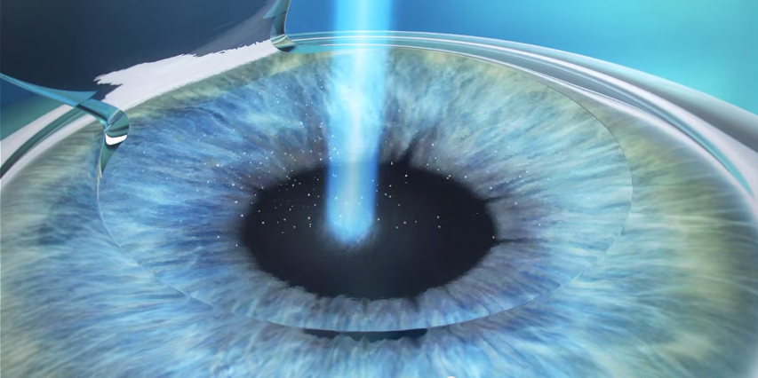 Cornú Visión - El Lasik es una cirugía refractiva para... | Facebook
