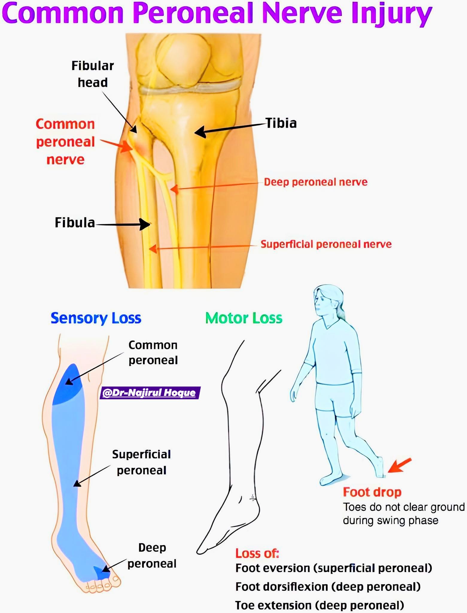 Human Anatomy Group | Common Peroneal Nerve Injury – Detailed ...