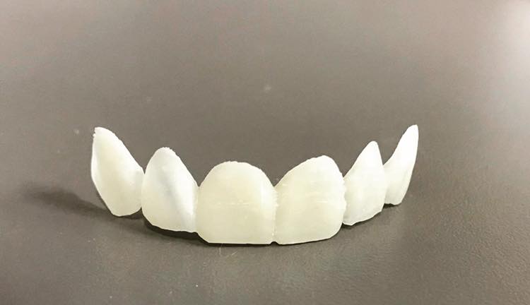 A 3D printed Digital Smile Design shell... - Mona Vale Dental