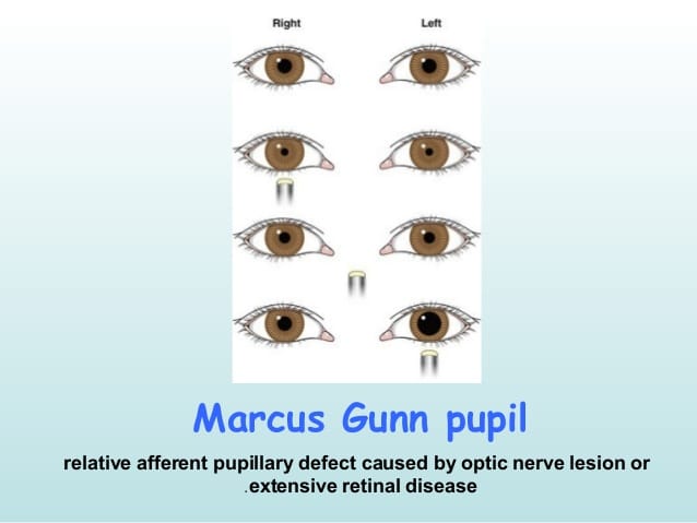 MARCUS GUNN PUPIL Marcus Gunn... - Being an Optometrist | Facebook