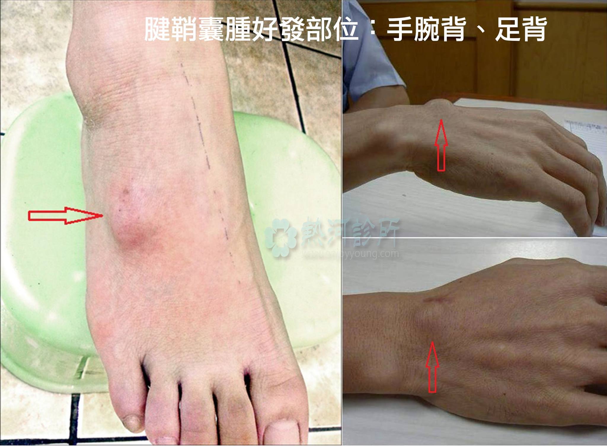 熱河診所 骨科復健 不痛不癢但很礙眼的小東西 手腳 腱鞘囊腫 案例分享 本身熱愛打球 忘記哪次運動後 Facebook