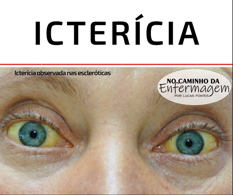 A icterícia é uma síndrome... - No Caminho da Enfermagem